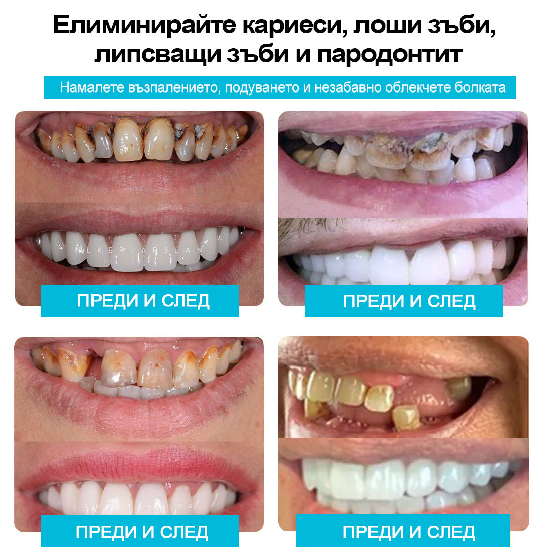 🦷𝑩𝒆𝒂𝒓𝒏𝒊𝒄𝒂™  Комплект протези със силиконова облицовка (⏰Ограничено време за отстъпка, само за 30 минути⏰)